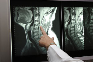 Personal injury attorney on lifetime spinal cord injury costs