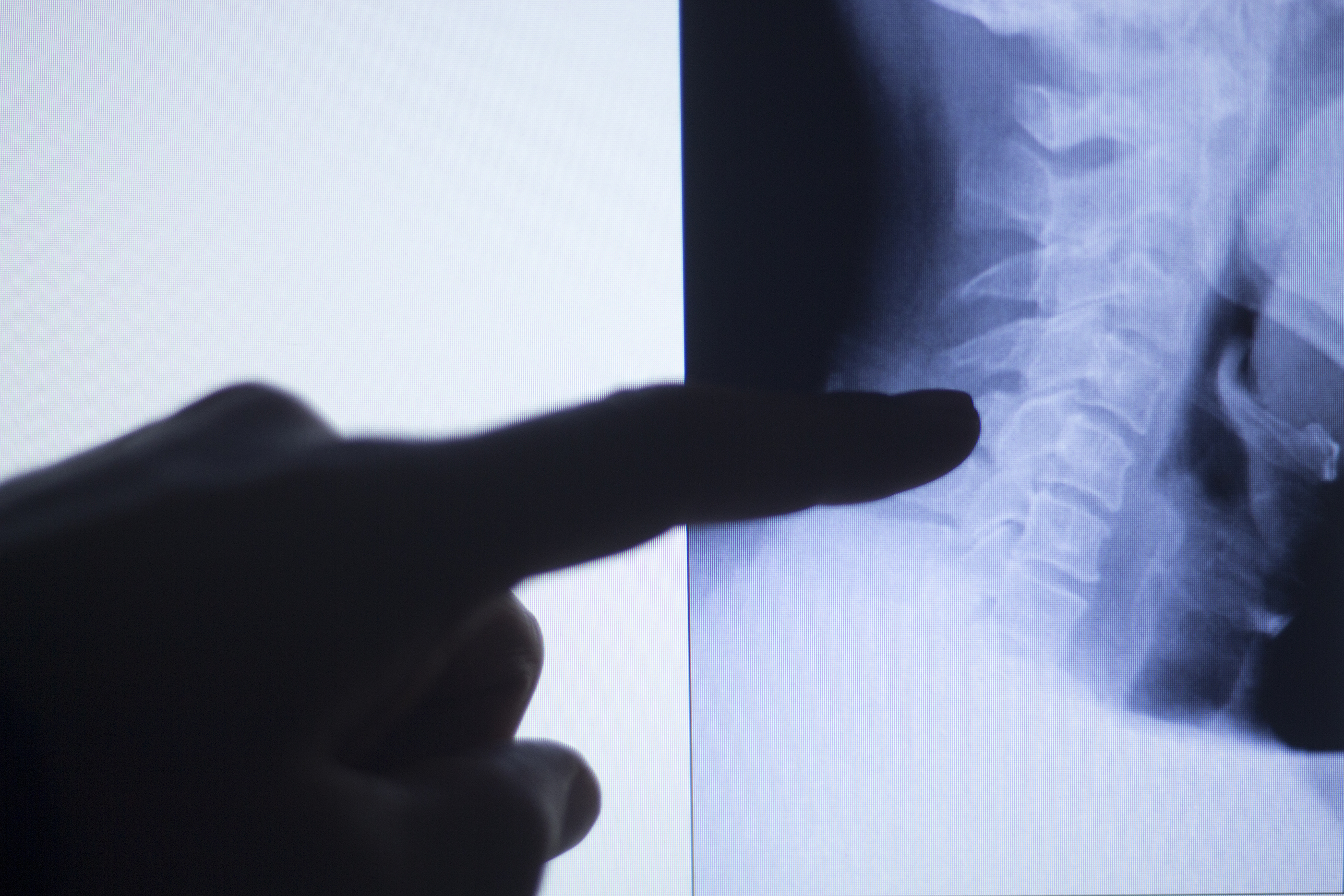Spinal Cord Injury of BMX Olympian